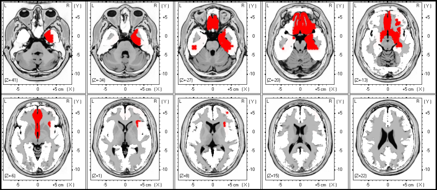 DELTA FREKVENCIASÁV (1.0-4.0 Hz) THETA FREKVENCIASÁV (5.0-8.0 Hz) 5. ábra. A LORETA képeken a delta (1.0-4.0 Hz) és a theta (5.0-8.0 Hz) frekvenciasávokban talált statisztikailag nem szignifikáns különbségek láthatóak.