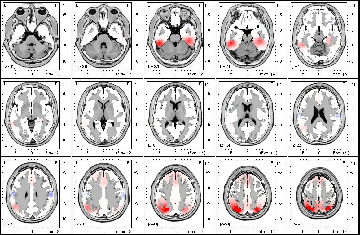 7. ábra. Az 1. csoport betegeinek csoportos LORETA-Z analízise. Az ábrán az emelkedett theta aktivitás temporalis, frontalis és parietalis területei láthatóak 7.0 Hz-es frekvenciaértéken vizsgálva.