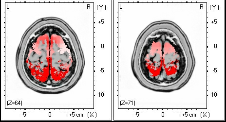 8. ábra. A 2. csoport betegeinek csoportos LORETA-Z analízise. Az ábrán az emelkedett theta aktivitás temporalis, frontalis és parietalis területei láthatóak 7.0.Hz-es frekvenciaértéken vizsgálva.