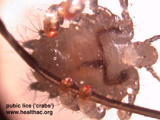 Phthirus pubis lapostetű Phthiraptera: tetvek (lice) kicsik, laposak, szárnyatlanok mind külső parazita madarakon, emlősökön kórokozók,
