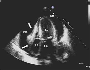 I./6.10. Pericardium punctio A szívtamponád a pericardialis nyomás fokozódása miatt bekövetkező szívelégtelenség.