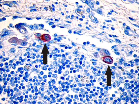 Sentinel nyirokcsomó nyirokcsomó Subcapsularis sinus