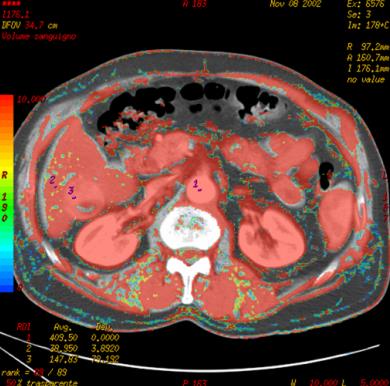 Májperfúzió BF BLOOD FLOW (BF) Az átáramló vérmennyiség (nagyerek, artériák, arteriolák, venulák, vénák és sinusok. Egysége ml/perc/100g szövet.