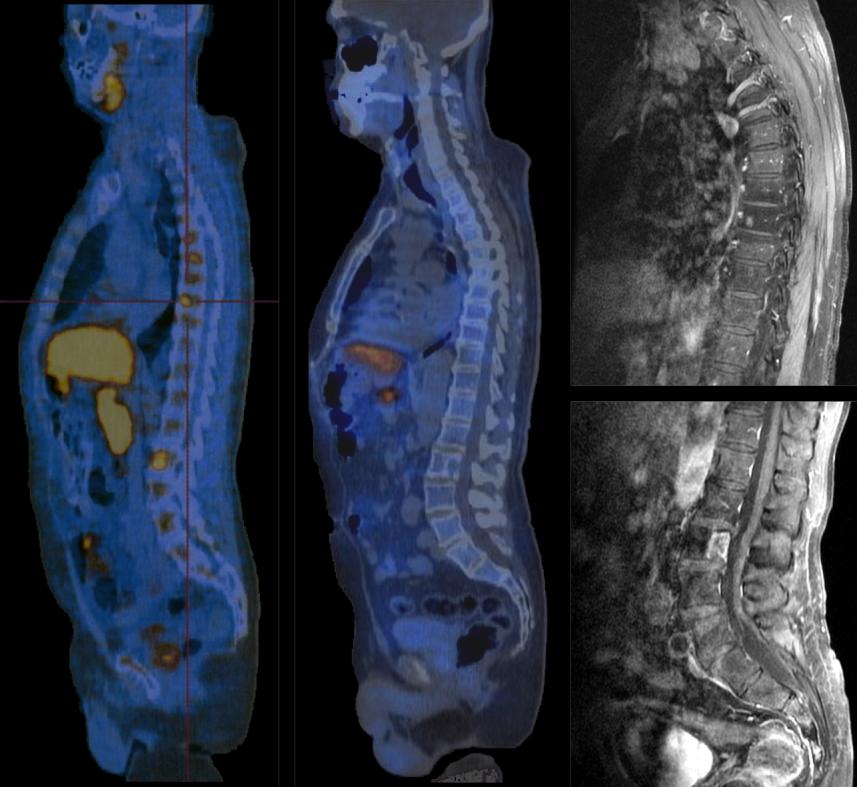 Bevacizumab plus erlotinib Balra: 11Cacetate PET-CT n látható ad8 és L2 csigolya érintettsége