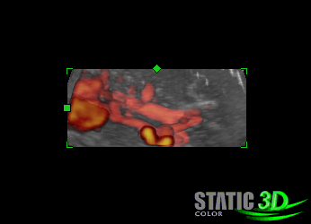 A 3D ultrahangkészülékek legújabb generációja már tartalmaz egy számláló software-t (pl.: VOCAL, Kretz ), amivel a szabálytalan képletek automatikus és manuális mérése egyaránt lehetséges.