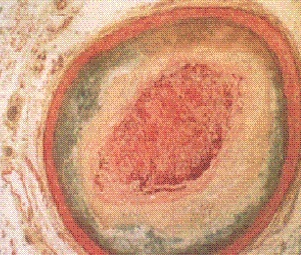 Egyéb etiológia Intracraniális stenosis Ischaemiás s stroke 10-29% Prognózis: