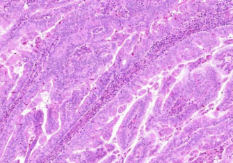 Kissejtes rák Differenciálatlan rák Egyéb Endometrialis hyperplasia Típusos hyperplasia Simplex Komplex (adenomatosus) Atípusos hyperplasia Simplex Komplex Endometrialis polyp Tamoxifen okozta