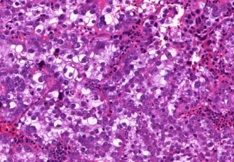 A méhtest daganatainak és daganatszerû elváltozásainak szövettani sajátosságai NYÁKOS (MUCINOSUS) MIRIGYRÁK Ebben a daganatformában a sejtek nagy része a sejtplazmában nyákot tartalmaz.