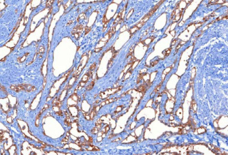 e) Myxoid leiomyoma A daganatsejteket nyálkaszerû alapállomány választja el egymástól, általában puhábbak, mint a szokványos simaizom-daganatok, és áttetszôek is lehetnek.