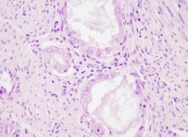 A hám össze tevô mirigyes vagy tömör, a mesenchymalis területek differenciálatlan sarcoma, leiomyo sarcoma, endometrialis stromalis sarcoma képét mutathatják, más esetekben idegen elemek fordulnak