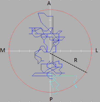 9. ábra. Jellegzetes stabilogramm. A- anterior, P- poszterior, M-mediális, L-laterális, R- a kör sugara. 10. ábra. A COP útja az idő függvényében anterior-poszterior (AP) és mediális-laterális (ML) irányban, valamint a teljes megtett út (T).