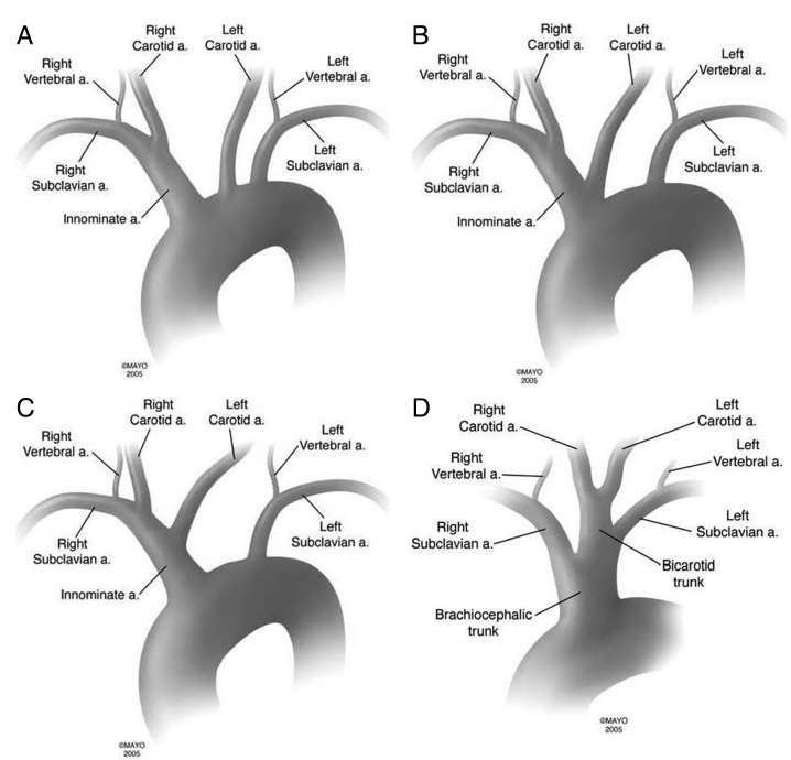 2.2. A supraaorticus érrendszer anatomiája, keringésélettana A supraaorticus erek kifejezés alatt az arcus aortae fej-nyak és felső végtag felé leadott ágait értjük.