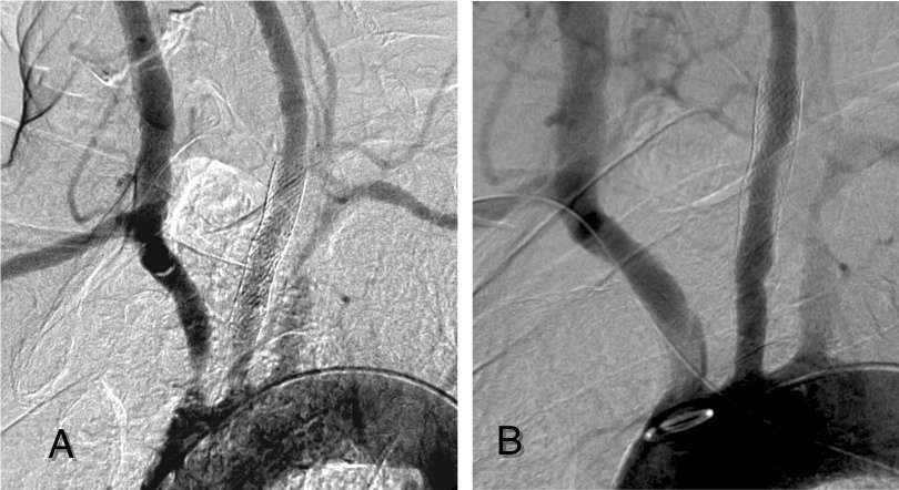 A postprocedurális első 30 napban nem regisztráltunk major stroke-ot, halálozást, vagy myocardialis infarctust.