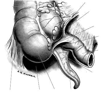 A peritoneum recessusai Recessus ileocaecalis superior Plica ileocaecalis Caecum Ileum terminale Recessus ileocaecalis inferior Plica caecalis Appendix vermiformis Recessus