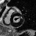 50 éves D1 occlúzió - PCI Csúcs CK: 560; MB: 62 non Q AMI MRI: 1