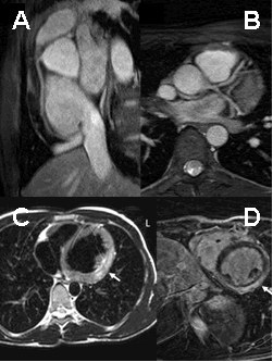 Transthoracic echocardiography: regional left ventricular dysfunction with focal hypokinesis of the mid inferior and inferolateral walls (E).