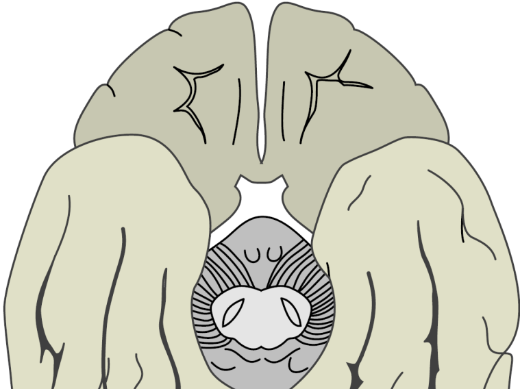 Dejerine (1890): egyszerű alexia Alexia: vizuális cortex és kapcsolata a bal féltekével