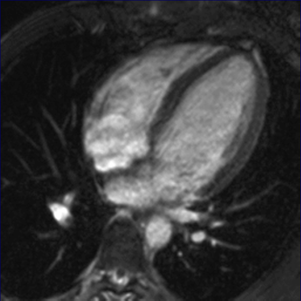 Terheléses szív MRI vizsgálat Nyugalmi 10 40 LV: EF 54, ESVi 54,