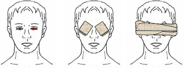 Szemsérülés: A szem sérülései viszonylag ritkának mondhatók. Mégis előfordulhat az, hogy idegen anyag bekerülése vérző, maró, stb. sérülést okoz.