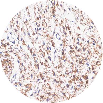 S-100 protein Klonális nyúl Klón: D28-E Kat. szám: DB 055-0.1 0,1 ml DB 055-0.2 0,2 ml DB 055-0.