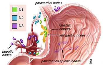 Gastric Cancer Staging Systems TNM: most important clinical prognostic