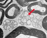 several axons to form a Remak bundle Nave, Schwab 2005 Corfas, Ramsay 2003 (4) or alternatively they single out larger axons and differentiate into myelinating