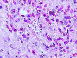 Cause diarrhoea and maladsorption as Cryptosporidium, but out of extraintestinal manifestations only acalculous cholecystitis has been reported Diagnosis is morphological in stool samples after