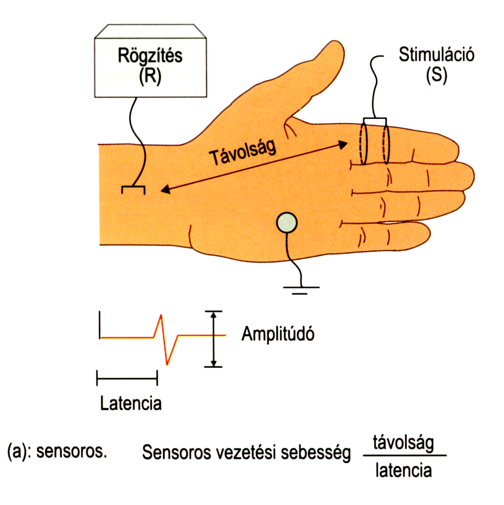 Idegvezetéses vizsgálatok A mielinizált szenzoros és motoros idegrostok ingervezetési sebességét és amplitúdóját vizsgáljuk a) szenzoros Az ábrán a szenzoros vezetési