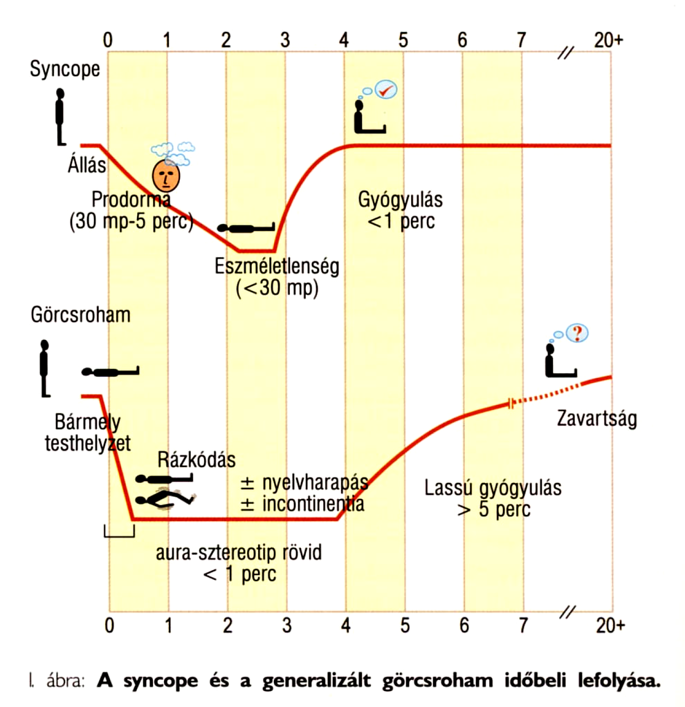 Eszméletvesztés=öntudatvesztés Syncope prodromális tünetek: szédülés, hányinger, homályos látás, izzadás hirtelen csökken a