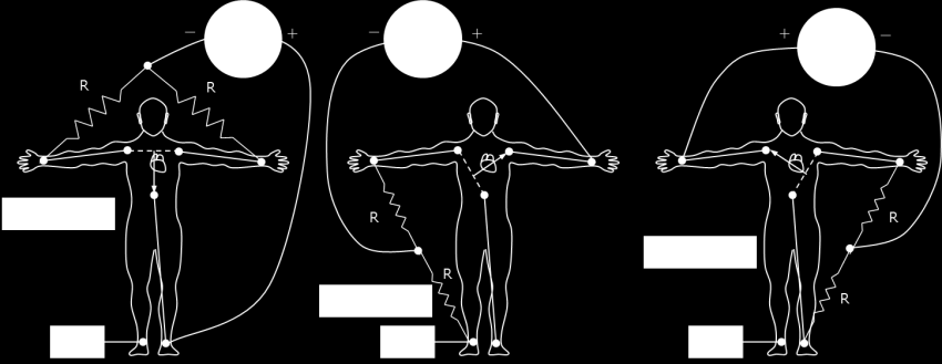 5. ábra Az Einthoven-féle hármas elvezetés (bal ábra) és az Einthoven-féle háromszög (jobb ábra) Einthoven megfigyelte, hogy ebben az elvezetésben bármely időpillanatban, bármely két elvezetésben