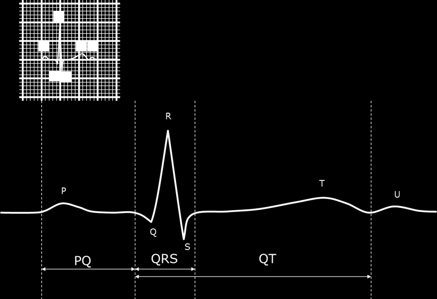 11. ábra Egy EKG készülék kezelőfelülete A normál EKG hullámok, intervallumok, szegmensek jellemzői A szív ingerképző és ingerületvezető rendszerének megfelelően