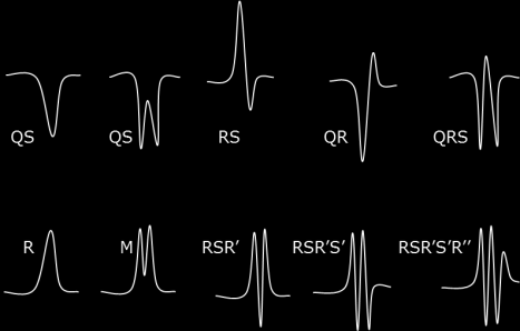 13. ábra A kamrai depolarizáció során megjelenő hullámformák és elnevezésük A QRS hullámok elemzésekor a következő 5. szempontot vesszük csak figyelembe: 1. QRS időtartama 2. Amplitúdója 3.