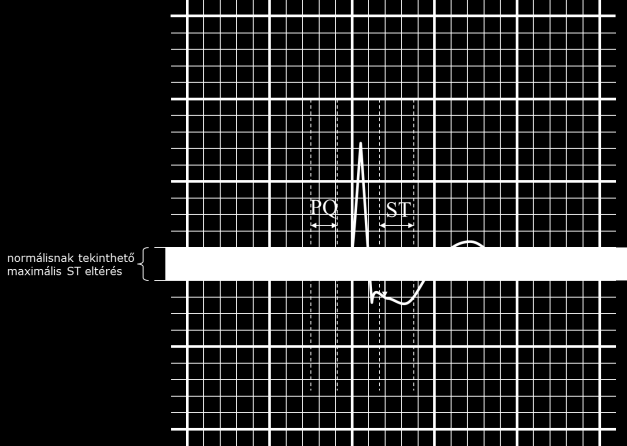 15. ábra Az E és J pontok helyzetének meghatározása az EKG görbén ST szegmens (ST szakasz) Az S hullám végétől a T hullám elejéig figyeljük az ST szegmenst (16. ábra).