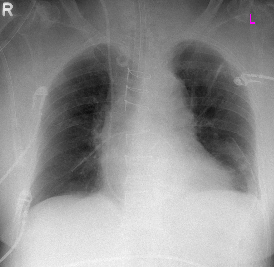 III. Pulmonális