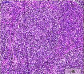 2.3. Follicularis lymphoma A follicularis lymphoma egy indolens, alacsony malignitású B-sejtes non- Hodgkin lymphoma (NHL), mely Európában és Észak-Amerikában az összes NHL körülbelül 20%-át teszi ki