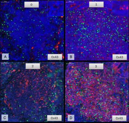 4.3.4. A fluoreszcens immunhisztokémiai metszetek értékelése A Connexin 43 expressziót vizsgáltuk nyirokcsomói lokalizációban, valamint a csontvelői tumoros infiltrátum területén is.