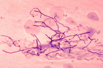 Gram negatív coccusok (Neisseriaceae) Gram negatív bacillusok (Escherichia coli) Gram negatív bacillusok (Pseudomonas aeruginosa) Gram pozitív coccus láncok hemokultúrában (Enterococcus faecalis)