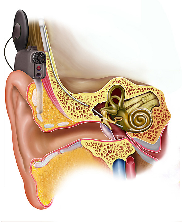 Cochlearis implantátum Kétoldali belsőfül eredetű nagyothallás/süketség esetén a külső hangforrásból