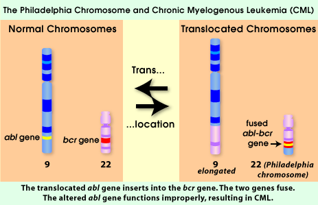 Transzlokáció mintapéldája: A Philadelphia kromoszóma A krónikus mieloid leukémiás betegekben található Philadelphia