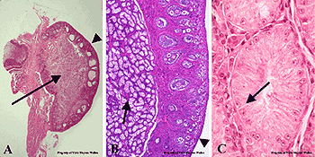 Valódi hermaphroditismus Ritka; ovarium és here szövet ugyanabban az egyénben; bilateralis vagy unilateralis ovotestis; prepubertális here éretlen tubulusokkal és éretlen Sertoli sejtekkel valamint