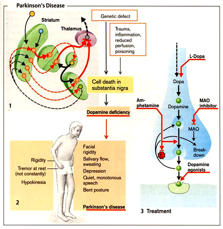 Parkinson kór Toxinok: CO, mangán, MPTP (metil-feniltetrahidropiridin) A