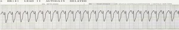 Gyermekkori ALS Nincs életjel és pulzus CPR + monitor VF/VT sokk 4J/kg CPR 2 percig Ritmuselemzés sokk 4J/kg CPR 2 percig Ritmuselemzés sokk 4J/kg CPR 2 percig Ritmuselemzés
