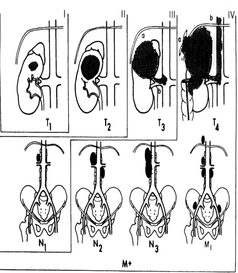 A vesesejtes carcinoma 1997-es TNM osztályozása PRIMER R TUMOR T0 Nincs primer tumorra utaló adat T1 Tumor <7 cm T2 Tumor >7 cm T3a Vese környezetének invázója T3b Vena cava inferior vagy vesevéna a