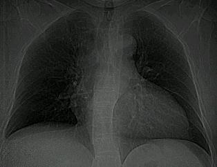tüdőembólia a mellkas rtg felvétel nem alkalmas a dg felállítására