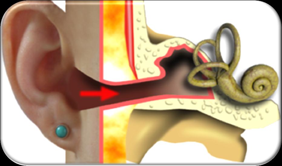 fistula-tünet izgalmi tünetek (nystagmus a beteg oldalra, Webert a beteg