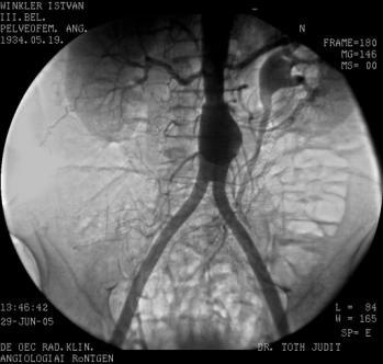 A perifériás artériás érbetegség (PAD) multilokularitása (Esetismertetés) A 73 éves férfi beteg esetén szignifikáns carotis interna stenosis és az alsó végtagok kritikus végtag ischaemiáját okozó,