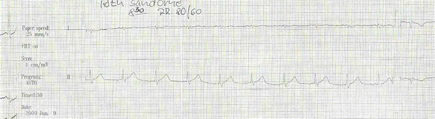 T.S-né EKG 1.