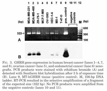 25 5. ábra Southern blot módszerrel, specifikus izotóp-jelölt próbát alkalmazva a traszkript genuin voltát igazoltuk, és további mintákban detektáltunk GHRH mrns expressziót.