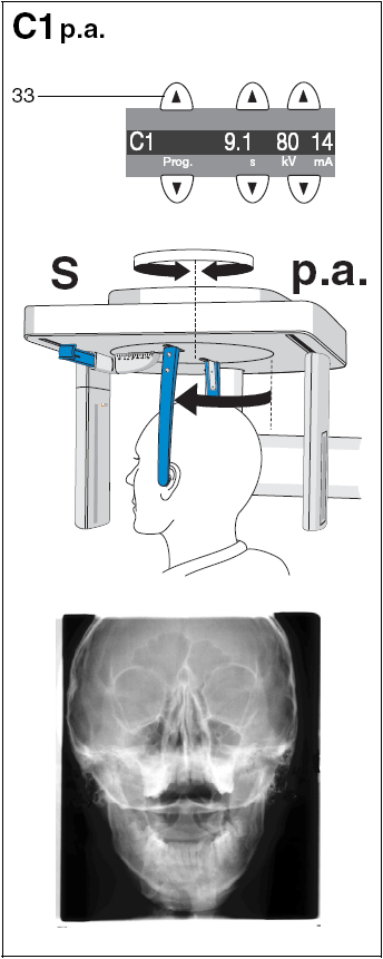 7 Kefalometriás felvételek (Ceph) C1 p.a. felvétel (S = szimmetrikus) Válassza ki a C1 ceph programot a program gombok (33) segítségével a Multipadon.