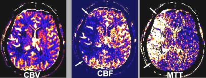 Az akut ischaemia korai finom CT jelei Az akut ischaemia korai finom CT jelei 1. Szürkeállomány denzitás csökkenése a. Törzsdúcok elmosódása b. Insularis szalag hipodenzitása c.
